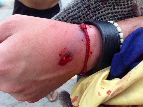 herido palaima3